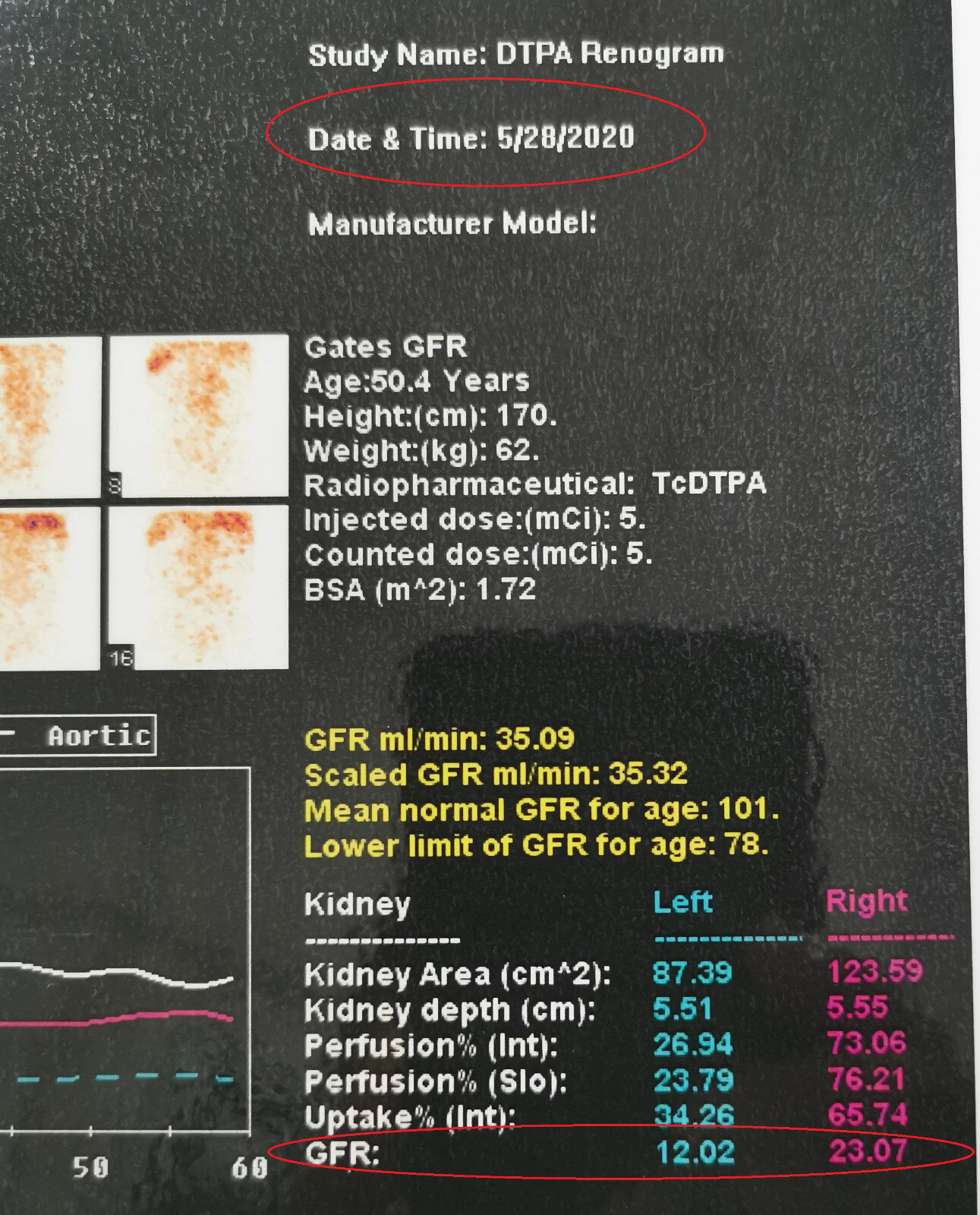 肾图GFR图片