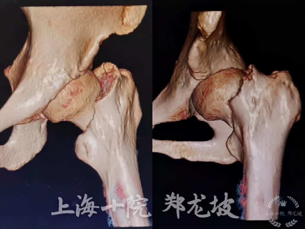 上海十院創傷骨科鄭龍坡教授團隊為一例頭下型垂直不穩定股骨頸骨折