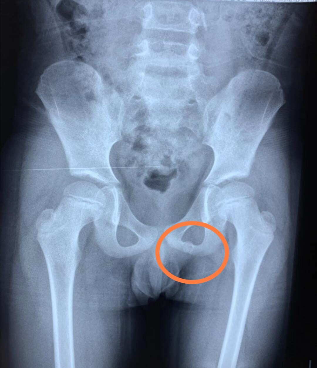 儿童骨骺炎 儿童骨骺炎