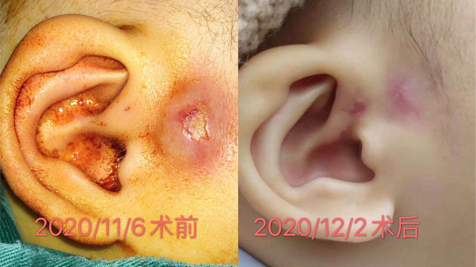 耳前瘘管手术后疤痕图片