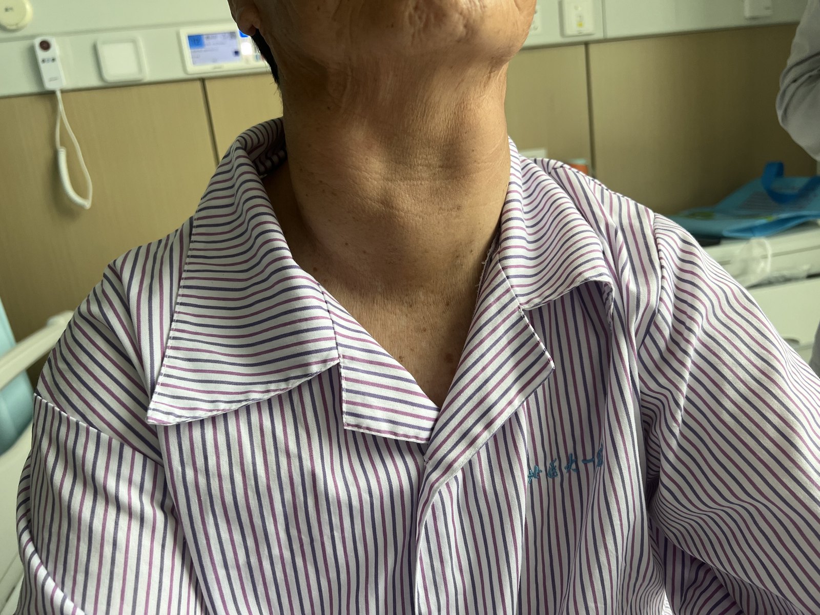 10厘米巨大甲状腺肿,形似盾甲