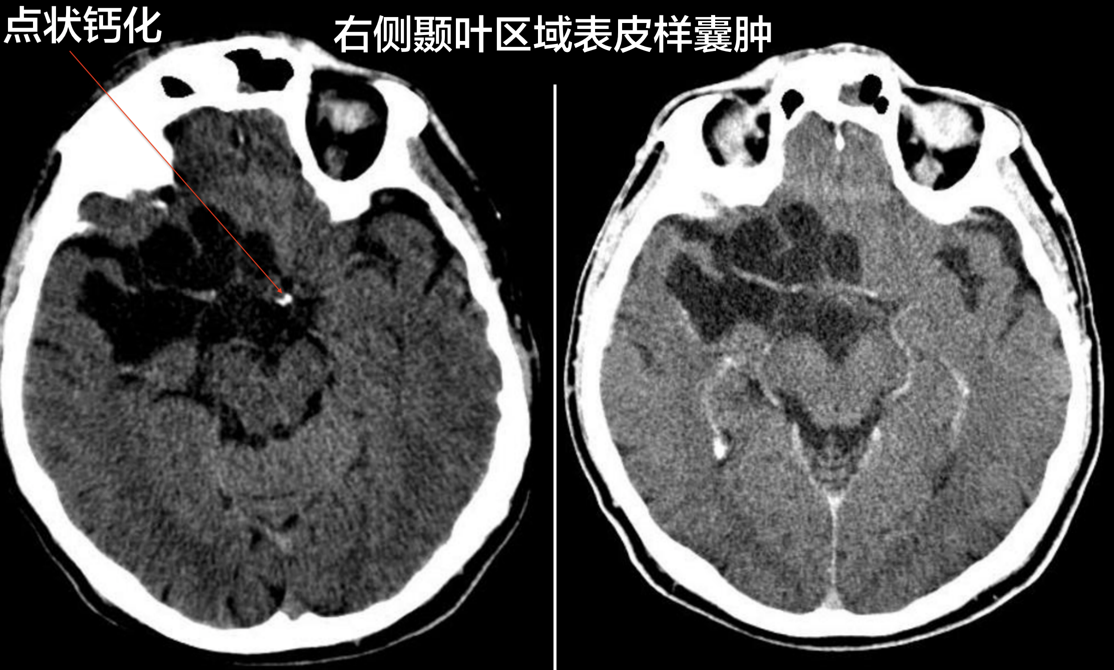 脑内囊肿图片