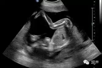 孕11 14周胎儿 结构畸形 的筛查 产前检查 产前检查介绍 好大夫在线 孕11 14周胎儿 结构畸形 的筛查 产前检查 产前检查介绍 好大夫在线