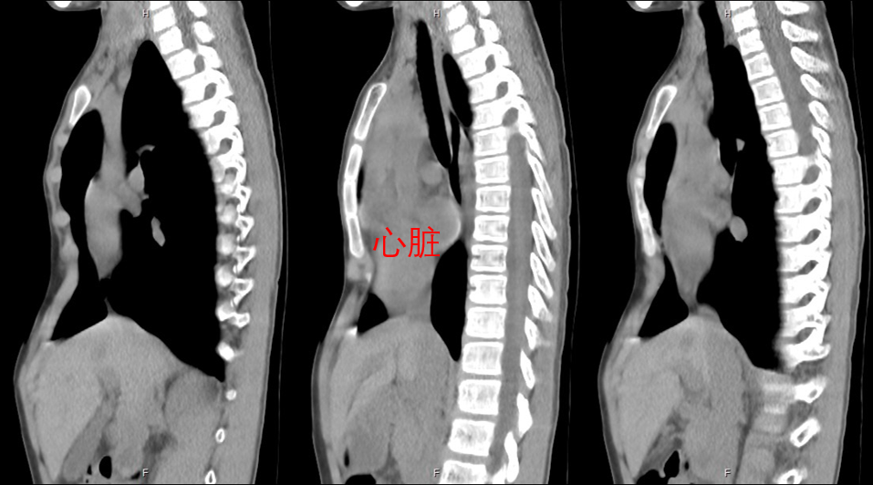 不对称漏斗胸微创手术治疗_漏斗胸微创矫正术_漏斗胸微创矫正术治疗