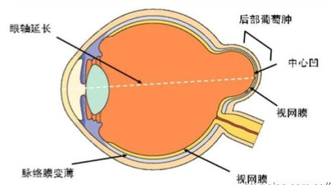 科普后巩膜葡萄肿是肿瘤吗