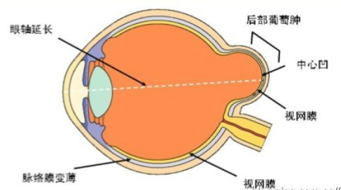 科普| 后巩膜葡萄肿是"肿瘤"吗?_巩膜葡萄肿_介绍_检查 - 好大夫在线