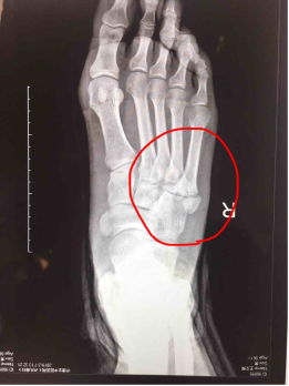 第五跖骨骨折怎么治疗 跖骨骨折 第五跖骨骨折怎么治疗 跖骨骨折
