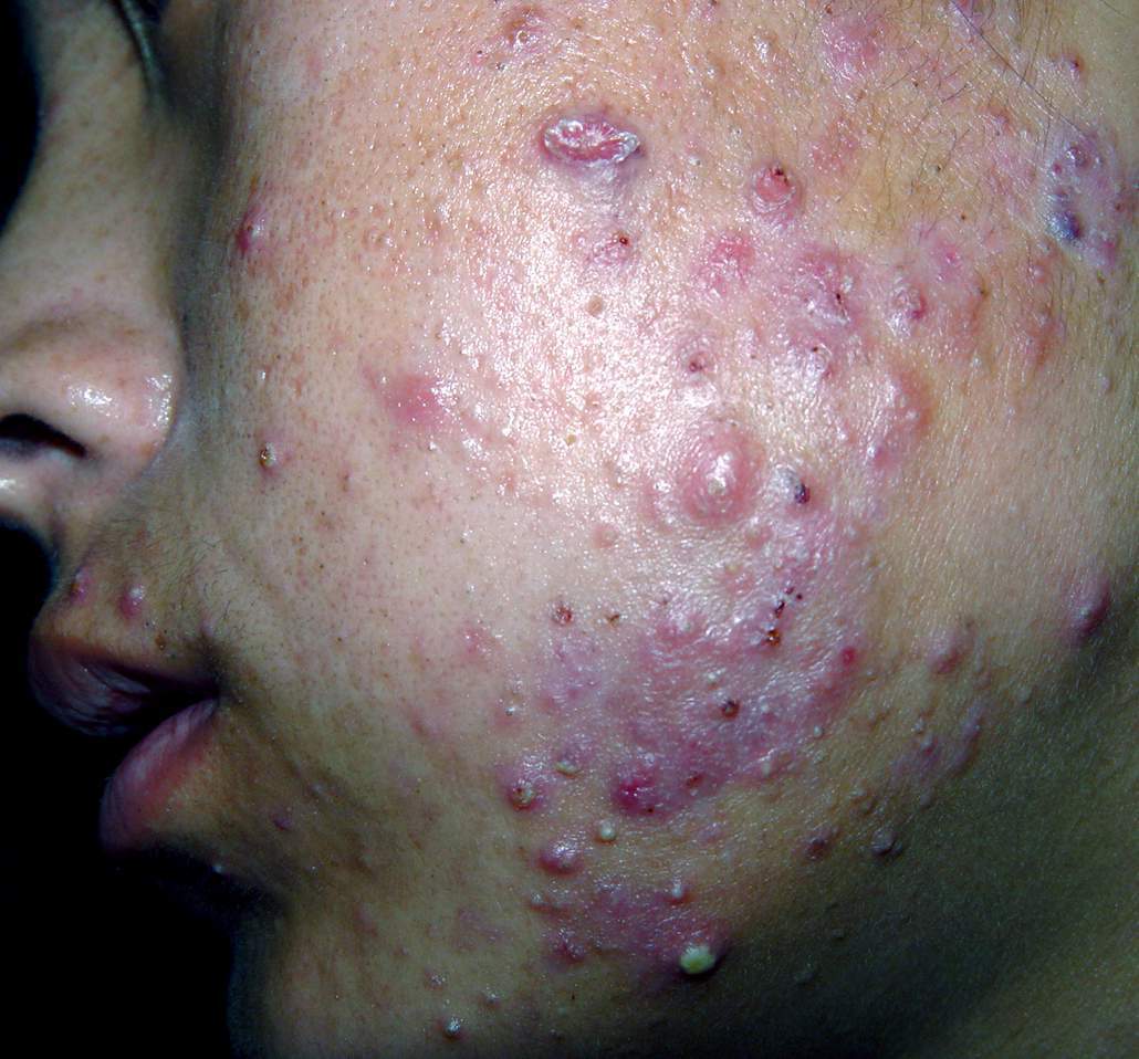 痤疮形成的另一个推手———痤疮丙酸杆菌_痤疮_痤疮发病原因 - 好