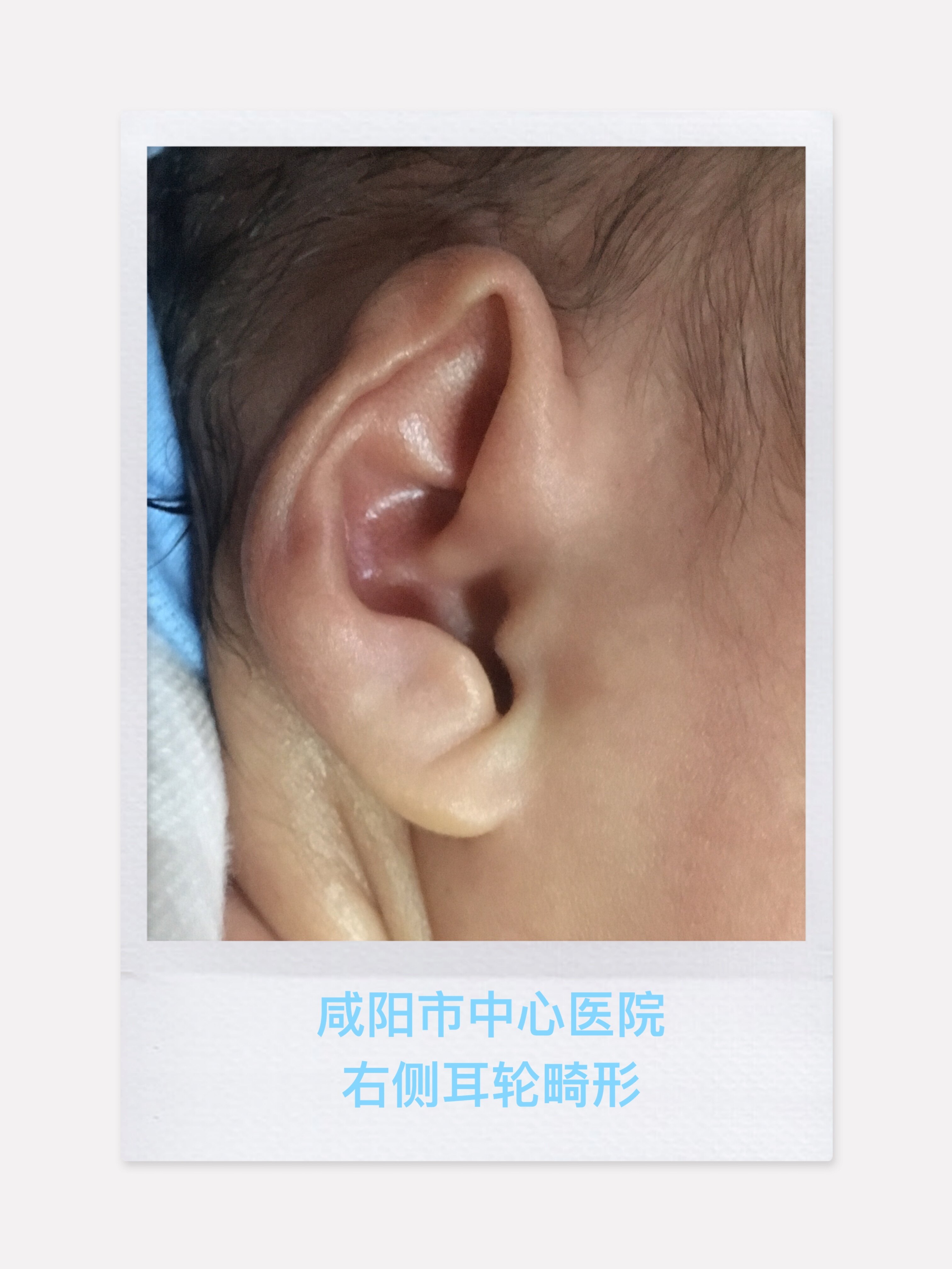 新生儿耳朵软骨压扁图图片