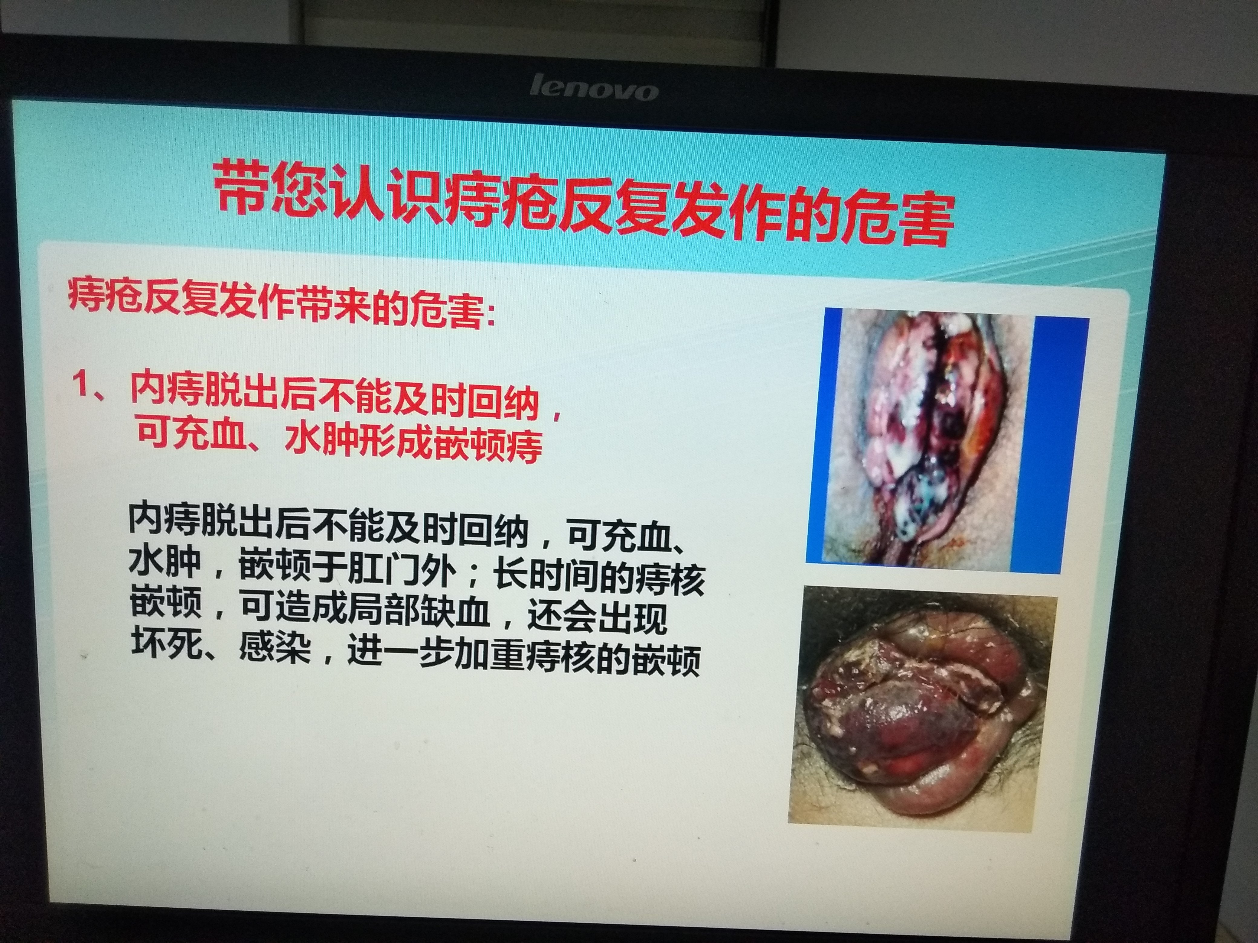 痔疮 - 好大夫在线