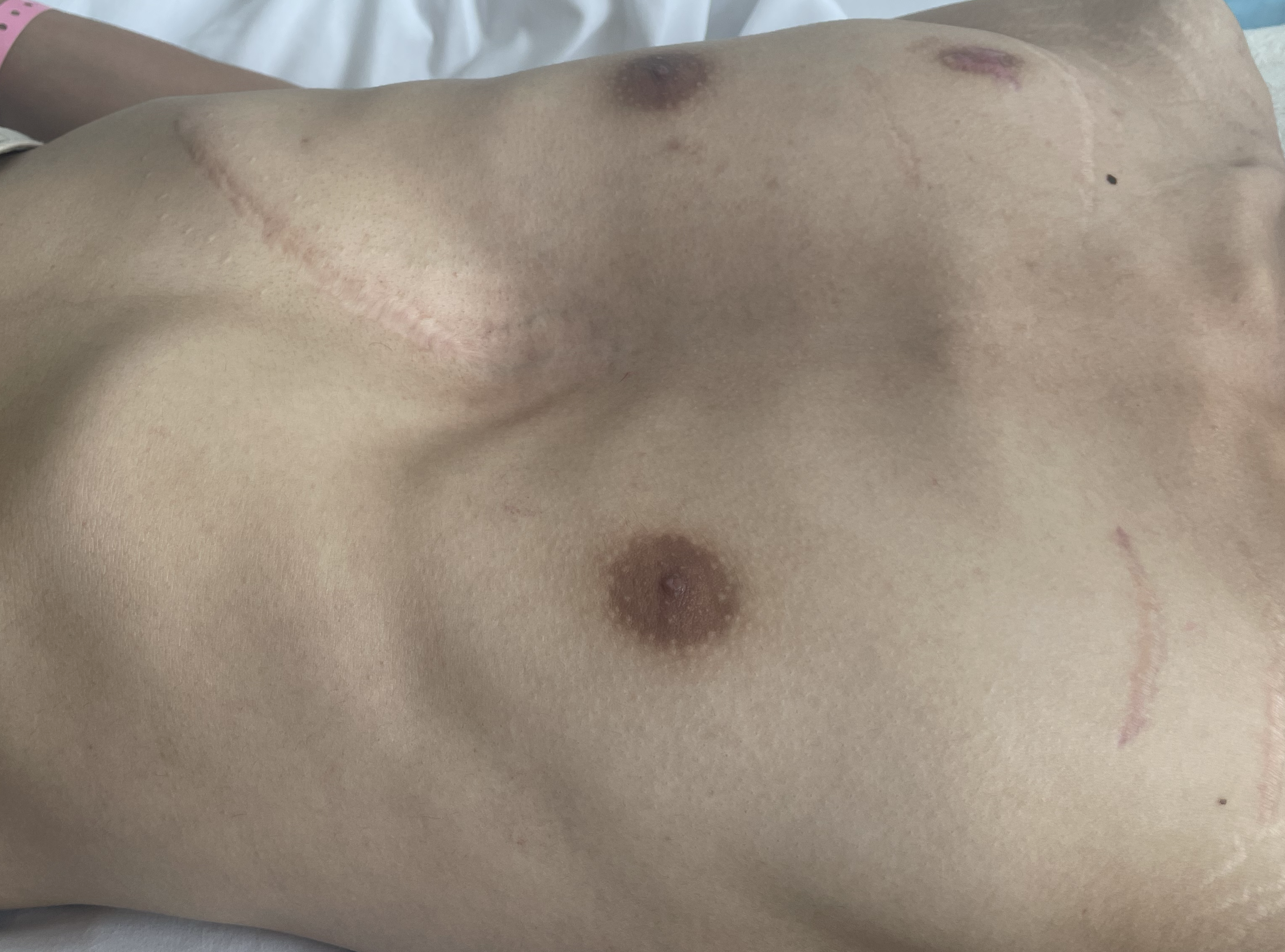 漏斗胸及超微创胸廓矫正术 漏斗胸 漏斗胸 漏斗胸及超微创胸廓矫正术 漏斗胸 漏斗胸