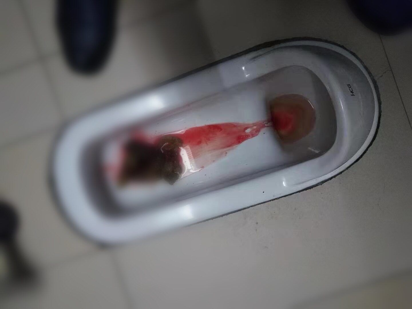 出血痔疮用什么药好_内痔疮最佳的自愈方法出血_出血的痔疮是什么痔疮