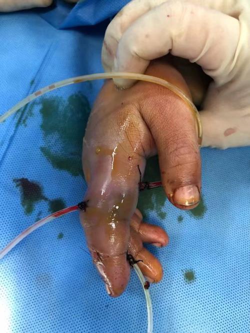 人咬伤临床表现多样,与咬伤部位相关,颌面部表现为出血与毁容,故治疗