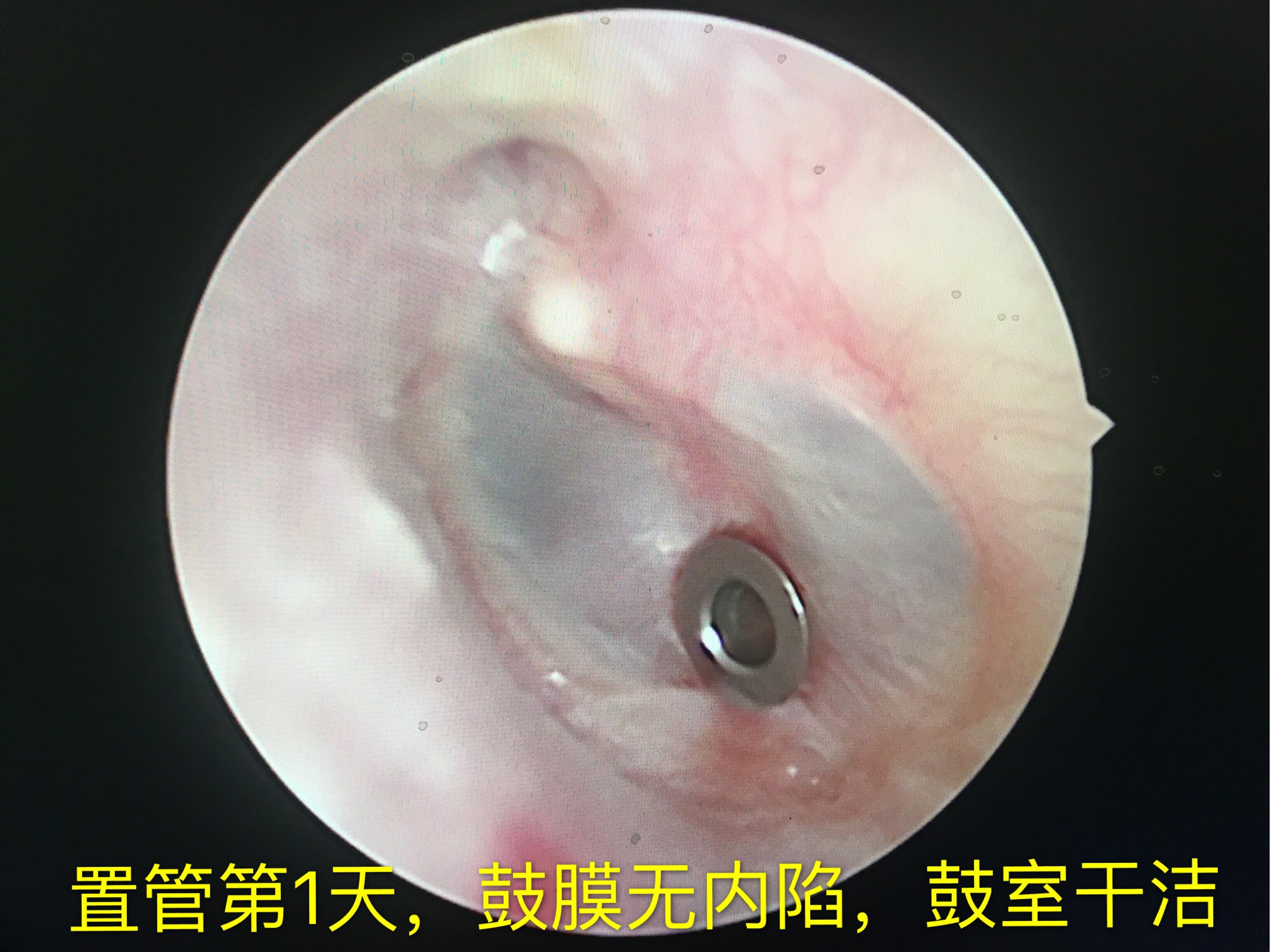 分泌性中耳炎 鼓膜置管 分泌性中耳炎 分泌性中耳炎