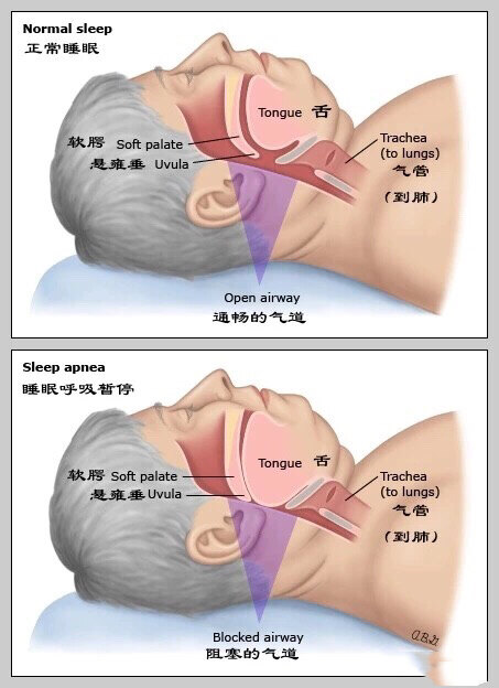 阻塞性睡眠呼吸暂停低通气综合征(osahs)9问