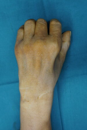 手麻肌萎缩2----肘管综合征的诊断与治疗_肘管综合征_发病原因_症状