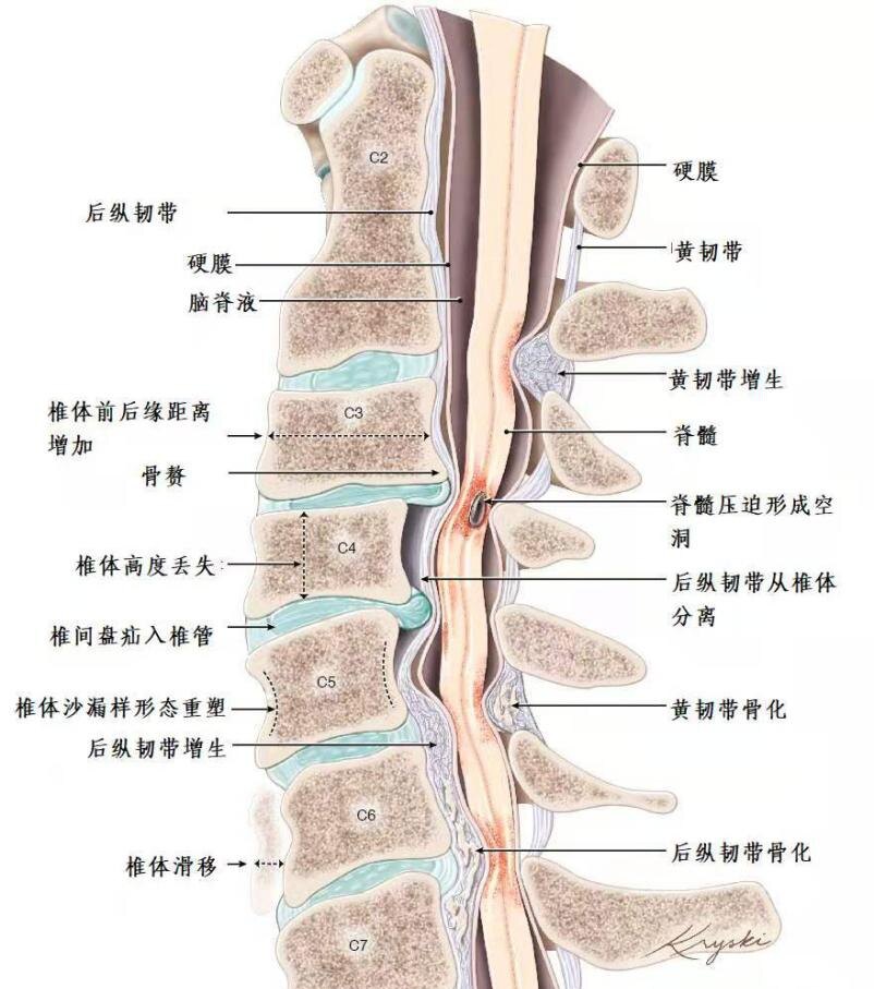 腰间盘突出自愈方法_腰间盘突出怎么自己恢复_腰间盘突出了怎么治