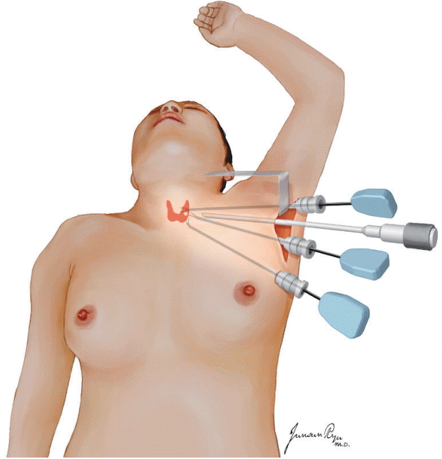 经腋窝甲状腺手术切口