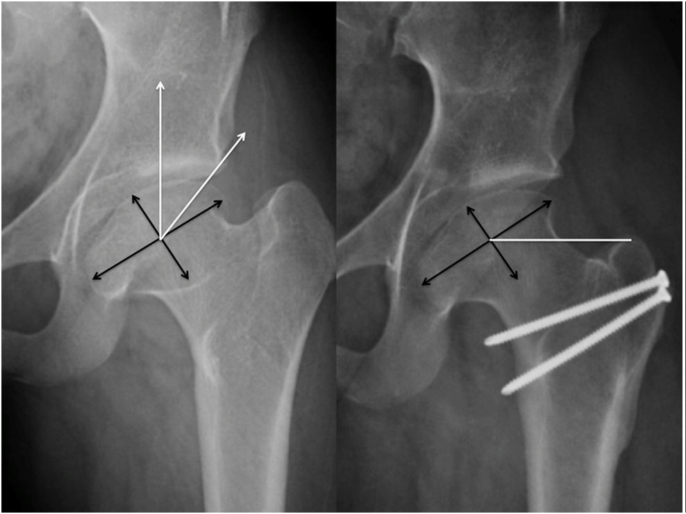儿童特发性股骨头坏死:perthes病后遗症:髋关节外科脱位和股骨颈相对