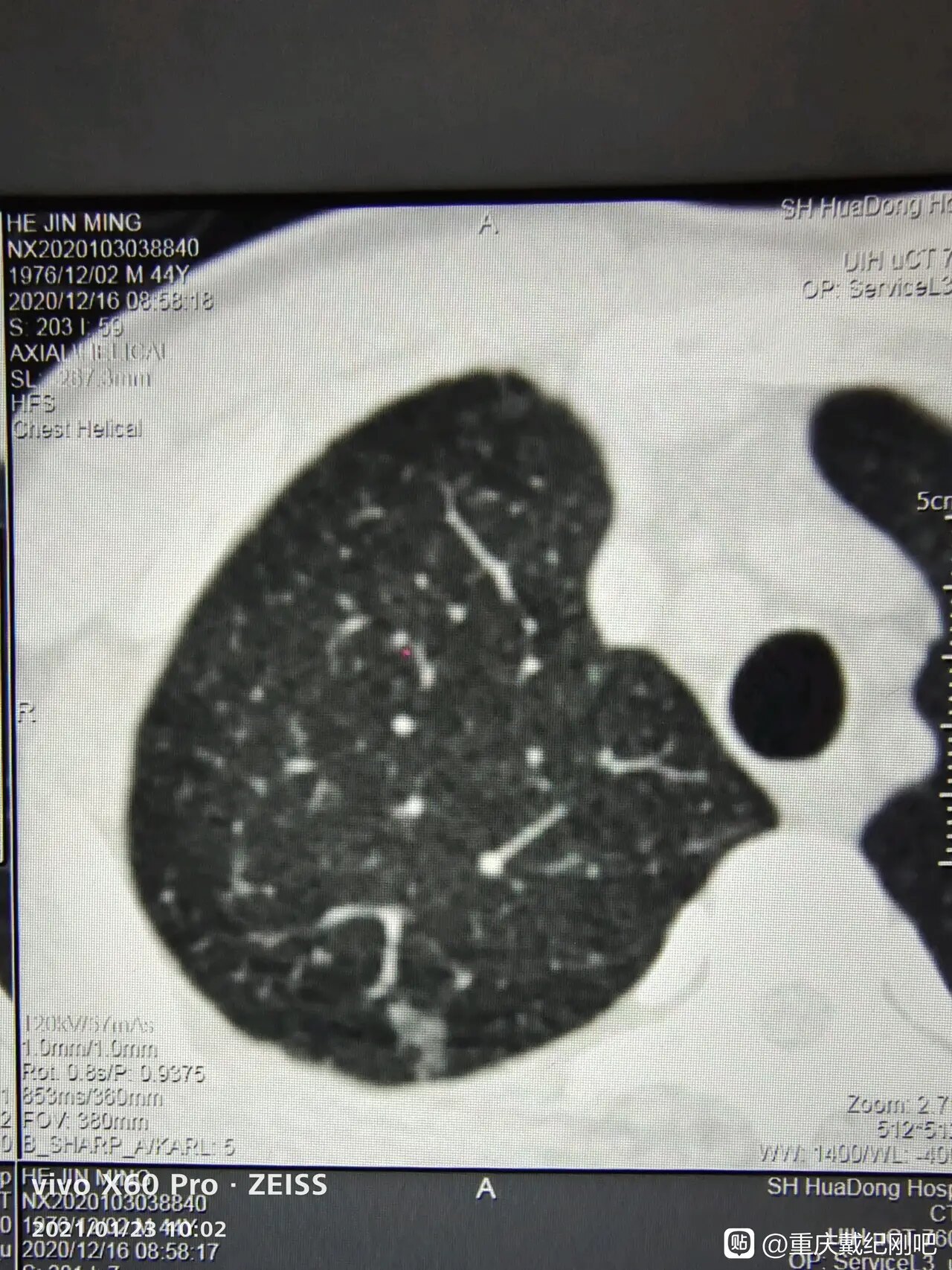 肺磨玻璃結節容易誤認為是小的斑片影磨玻璃結節的精準診斷需要薄層ct