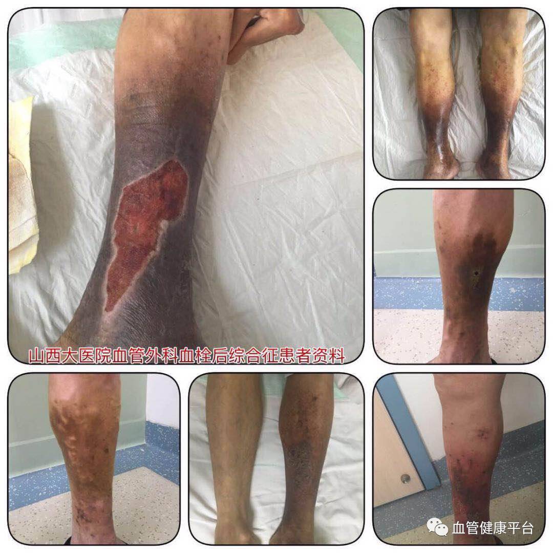 隐形杀手静脉血栓栓塞症 深静脉血栓形成 深静脉血栓形成 隐形杀手静脉血栓栓塞症 深静脉血栓形成 深静脉血栓形成