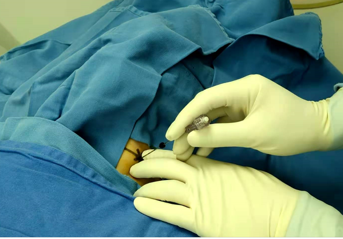 颈椎病,腰椎间盘突出症:精准治疗,只要一根穿刺针,将微创做到极致