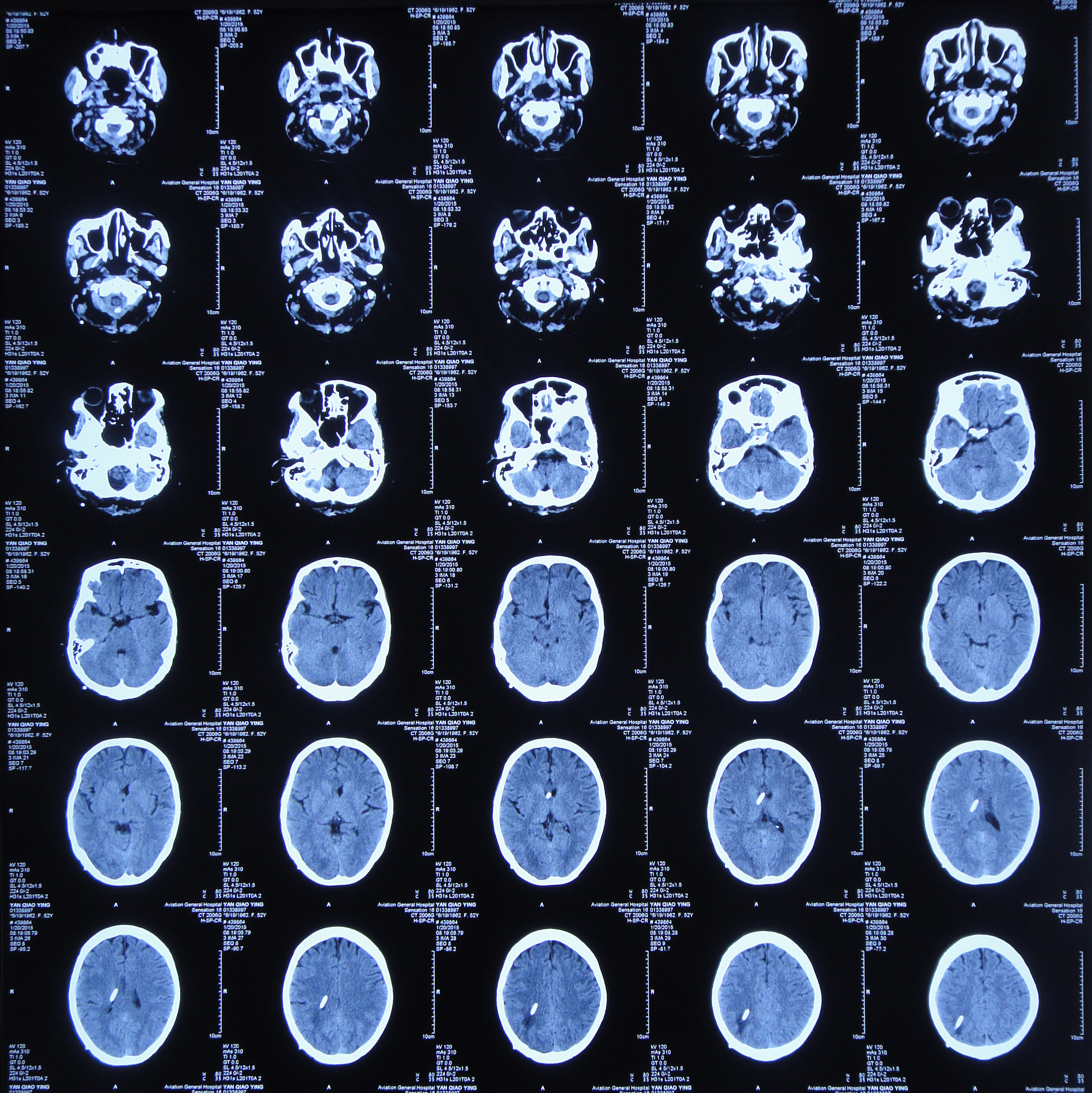 颅脑ct正常图像图片