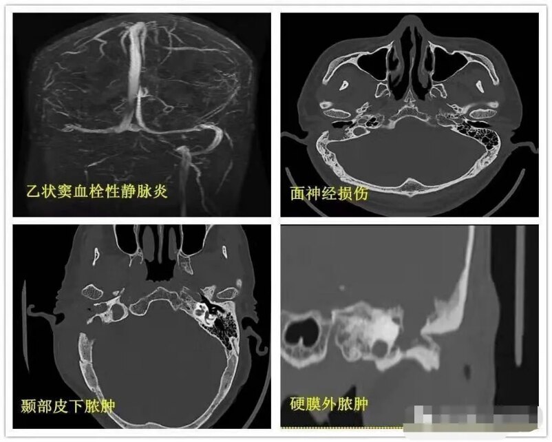 化脓性中耳炎_急性化脓性中耳炎_介绍_症状表现 - 好大夫在线