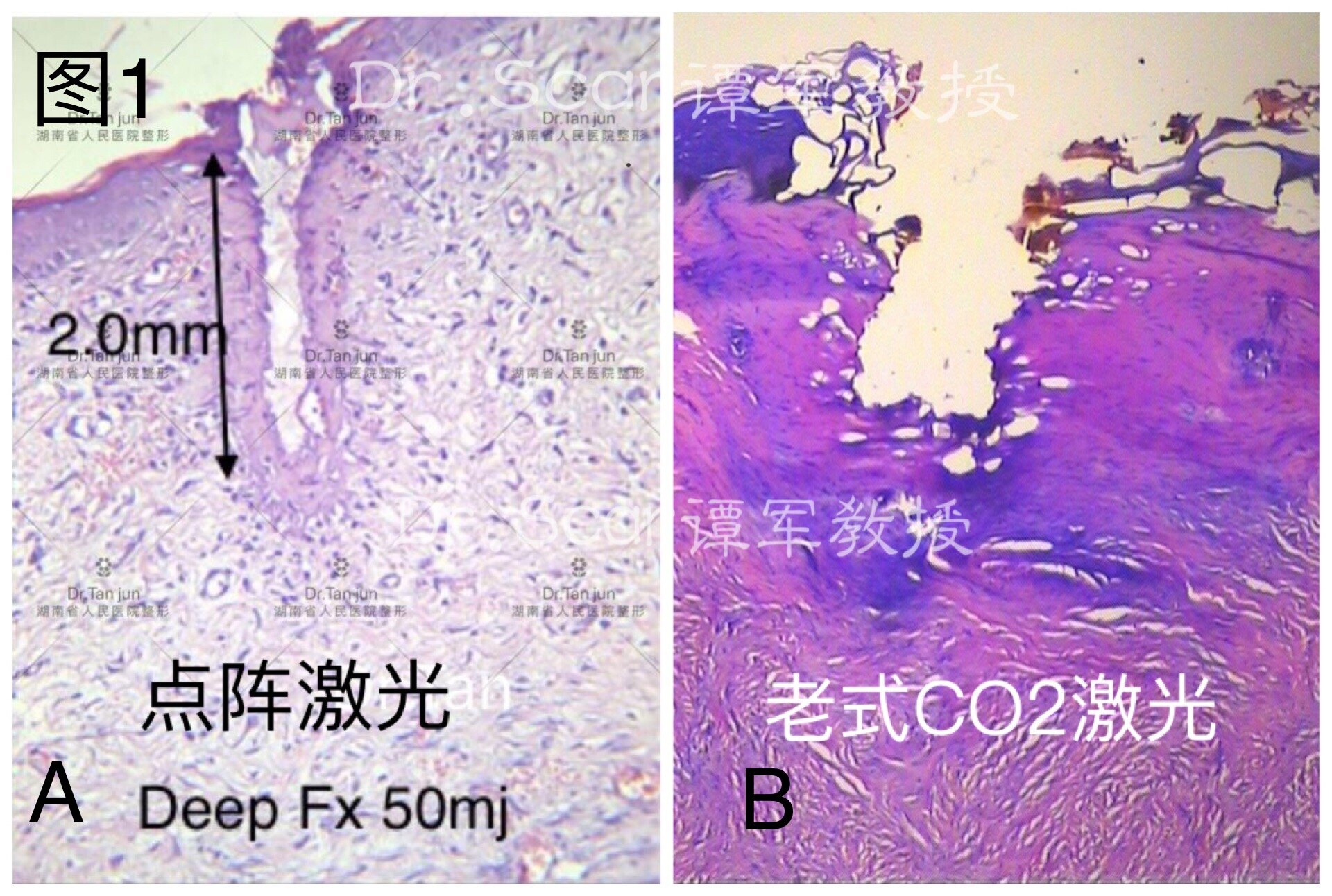 点阵deep fx组织病理学观察b:连续脉冲co2激光组织病理学观察真假点阵
