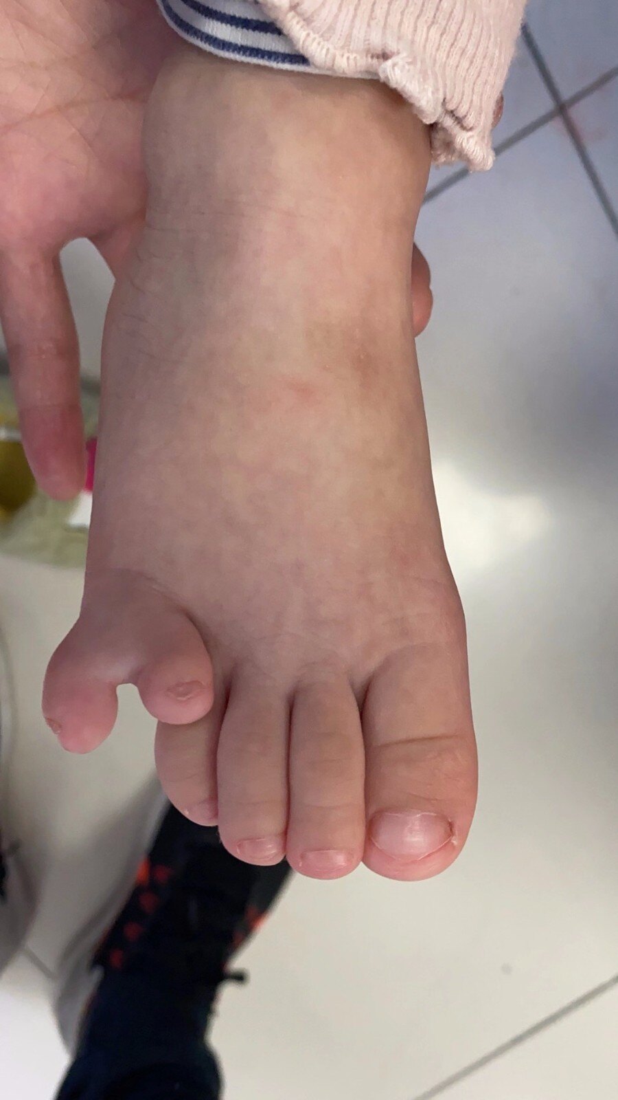 儿童足趾多趾畸形手术治疗 