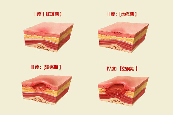 褥瘡咋治比較好傷口管理time原則加快修復