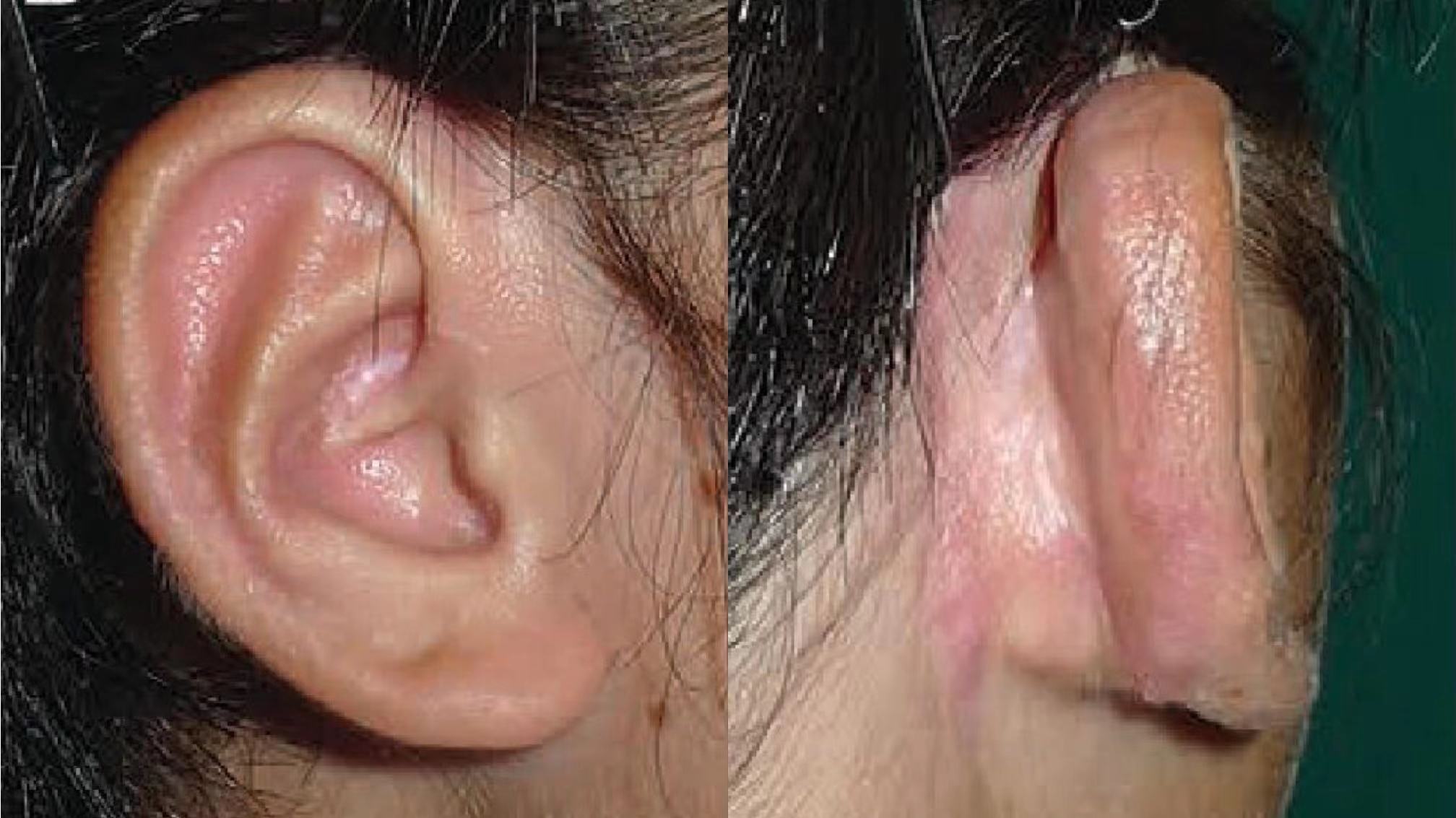 耳甲腔型小耳,只做二次手术的直埋二期法耳再造术_耳再造_治疗方式