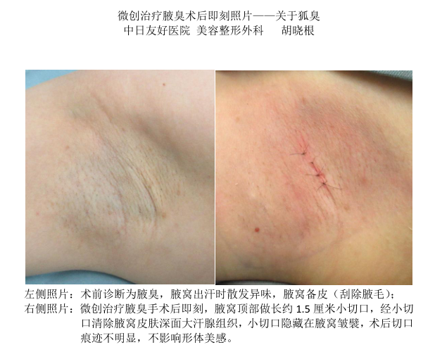 选择杭州腋臭手术治疗哪家更靠谱?