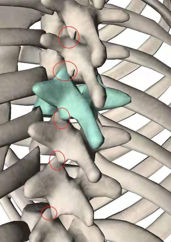 強直性脊柱炎強直性脊柱炎(ankylosing spondylitis, 簡稱as)是一種