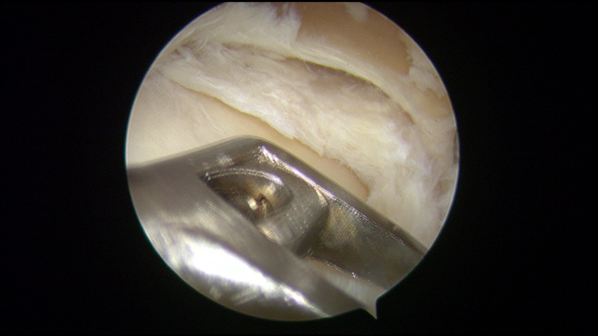 盘状半月板成形手术