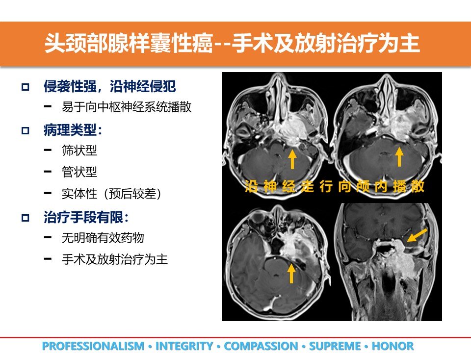 质子重离子放射治疗让头颈部腺样囊性癌不再难治 腺样囊性癌