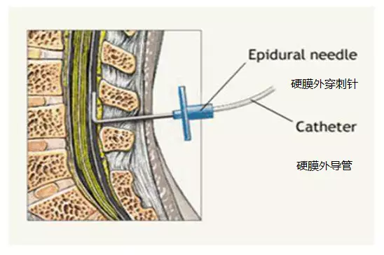 硬膜外隙图片