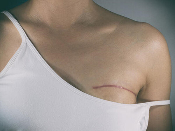 乳腺癌铠甲胸图片图片