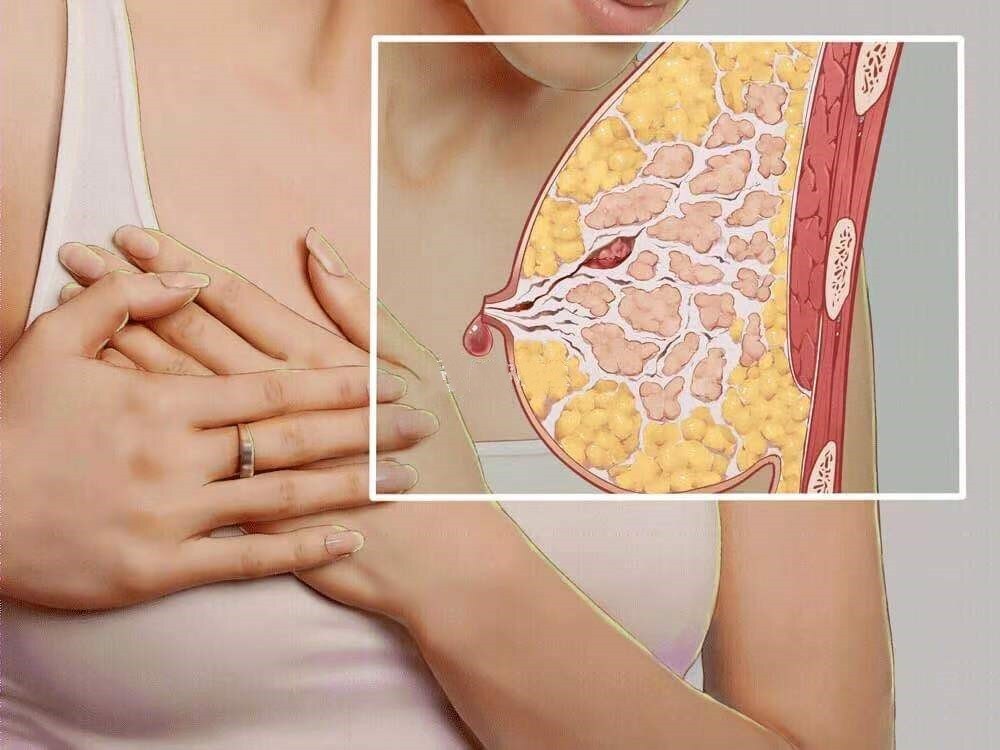 晚期乳腺癌图片大全_乳腺癌晚期症状图片真人_乳腺癌晚期症状图片是怎么样的