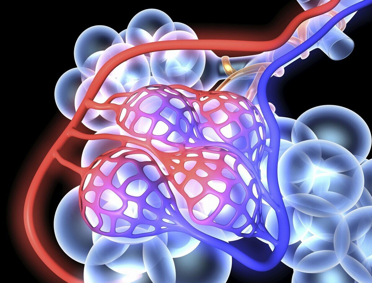 抽烟引起肺大泡怎么才能治好 用药是消不掉的 现在有新办法 肺大疱