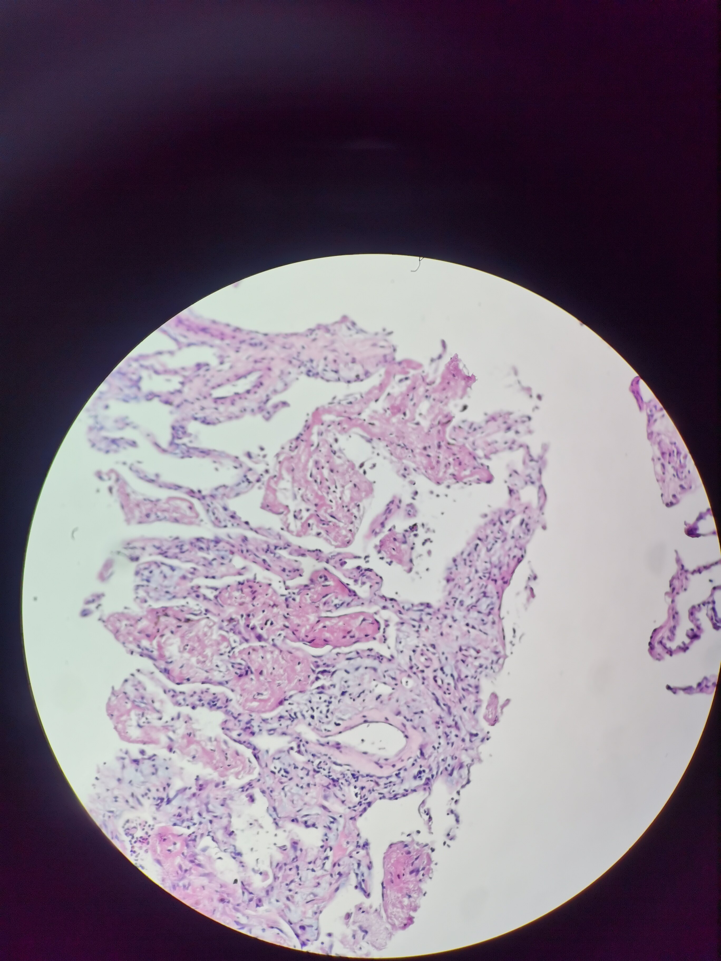 肺典型机化性肺炎组织学改变 - 好大夫在线