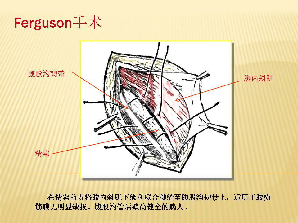 加拿大的edward earle shouldice医生是对疝手术做出极大贡献的专家