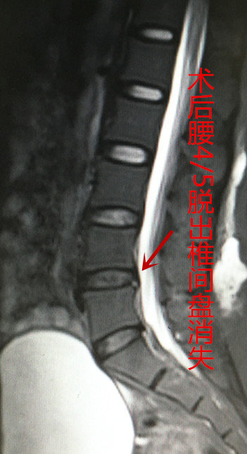 腰椎4-5椎间盘膨出图片