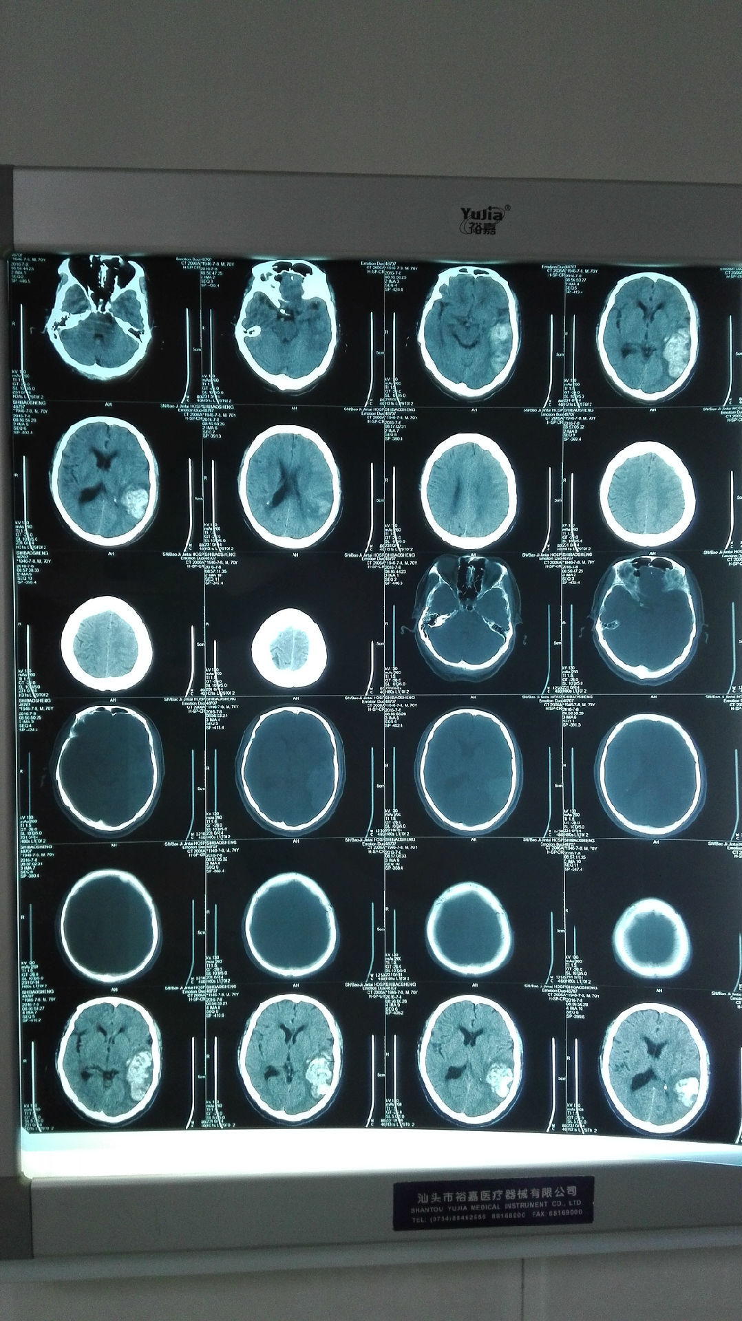 术中清除完血肿,见1x1cm3海绵状血管瘤,并仍在出血,一并切除.