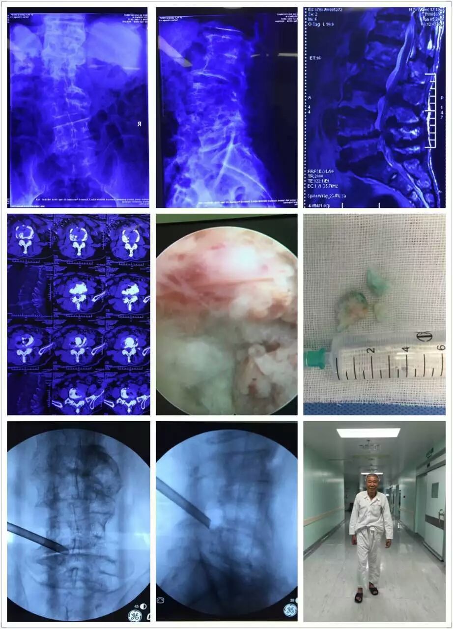 微創手術治療腰椎滑脫症並椎管狹窄 - 好大夫在線