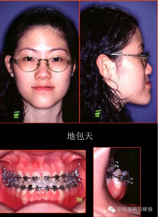 龅牙,地包天,小下巴和方脸牙颌面畸形的正颌外科治疗(一)