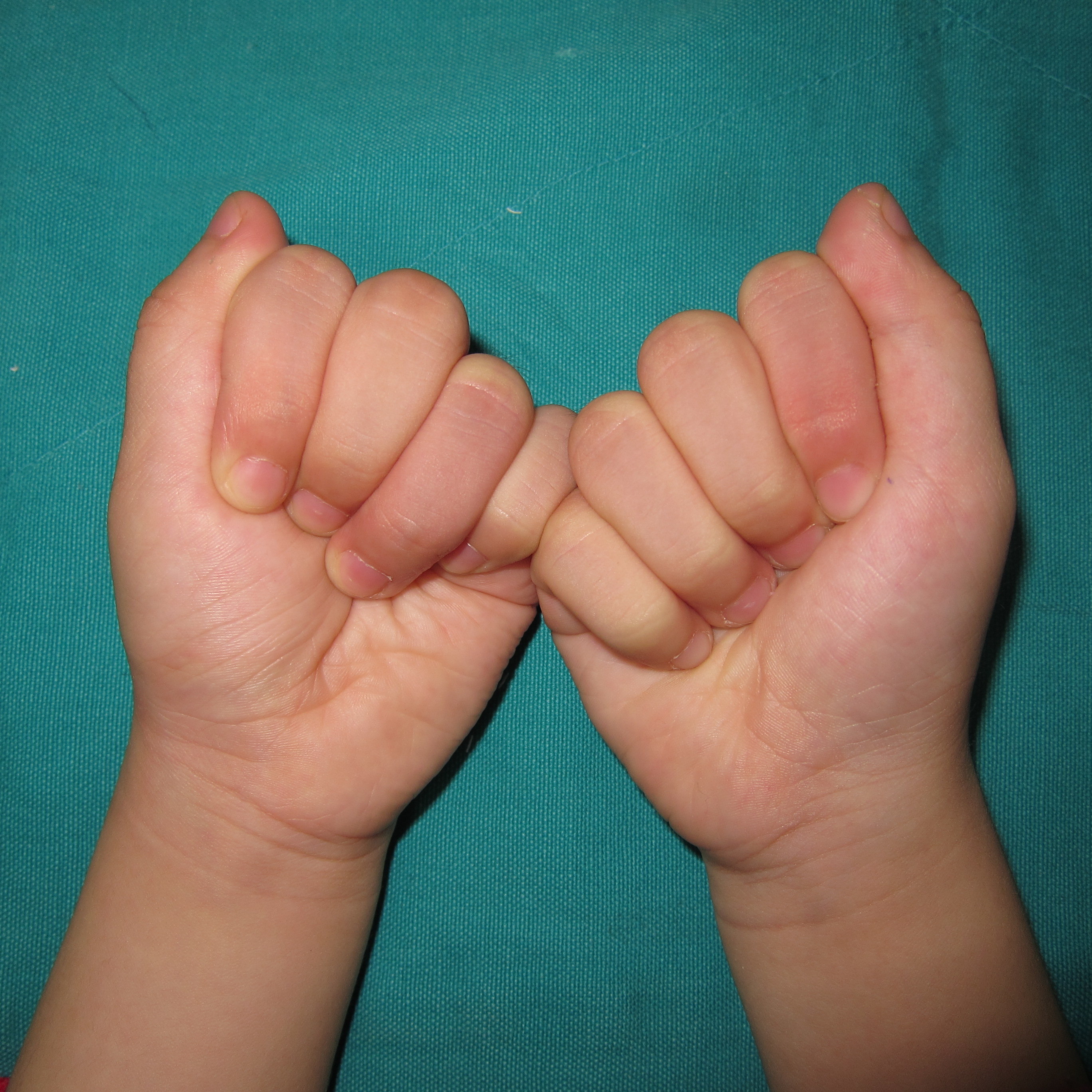 小儿输液后掌指关节僵硬