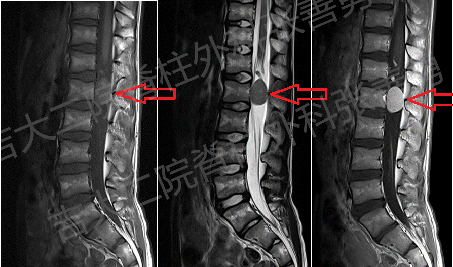 腰椎神经鞘瘤图片