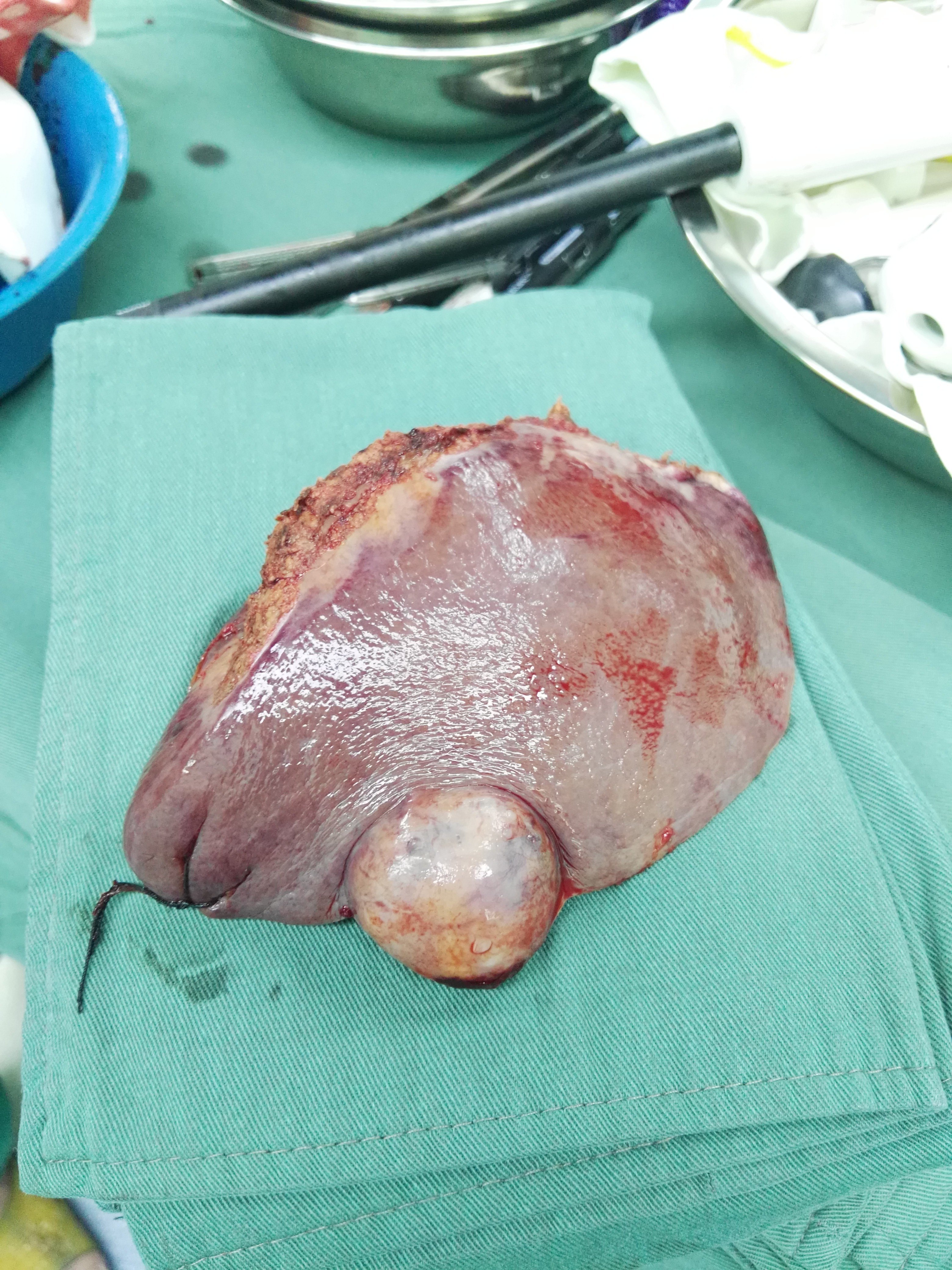 肝左外叶小肝癌