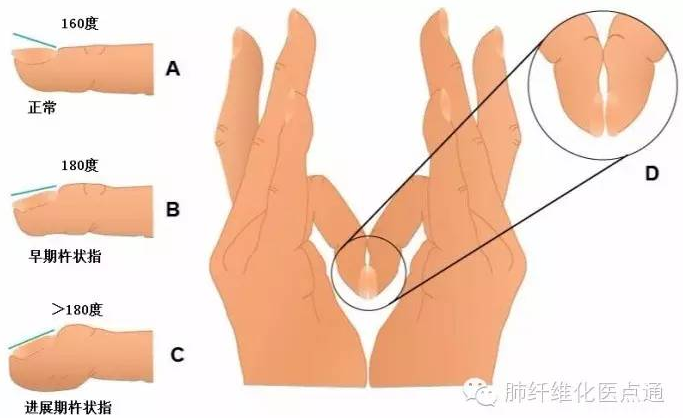 三分钟读懂呼吸科常见体征 杵状指